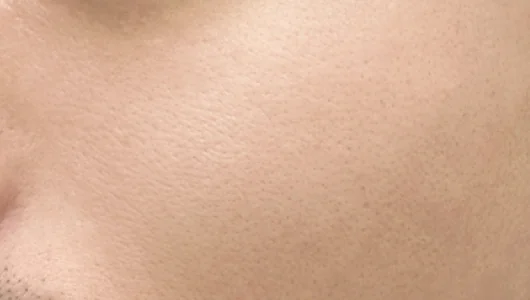 手術後の肌のクローズアップ写真