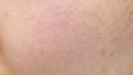 肌のクローズアップ、手術後の状態を示す