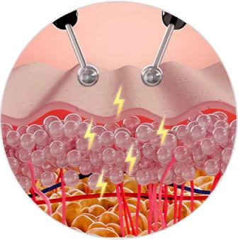 電極で皮膚に電気刺激を与えている様子。