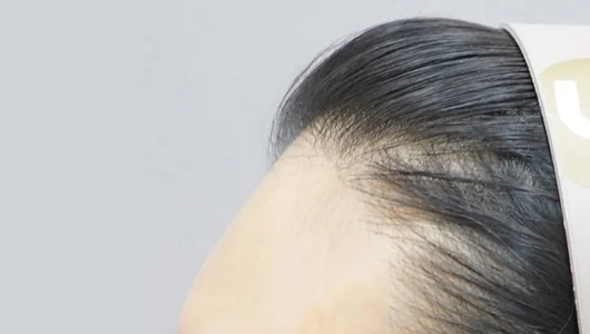 額の生え際と黒髪のクローズアップ写真