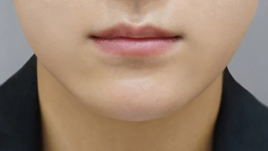 唇のフィラー施術前の、女性の唇のクローズアップ写真