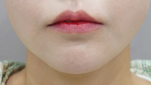 リップフィラー施術前の唇のクローズアップ写真