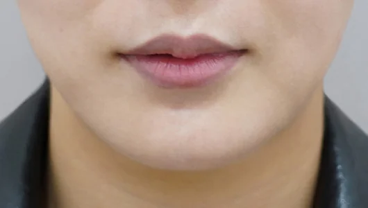 施術前の、唇のアップ。