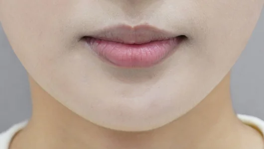 リップフィラー施術前の、女性の唇のクローズアップ写真。