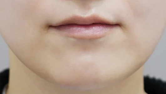 リップフィラー施術前の唇のクローズアップ写真。