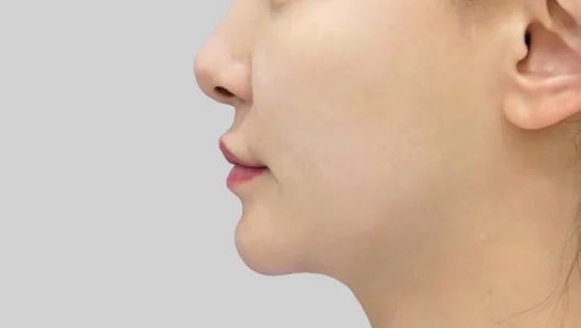 女性の顔の横顔、輪郭手術後