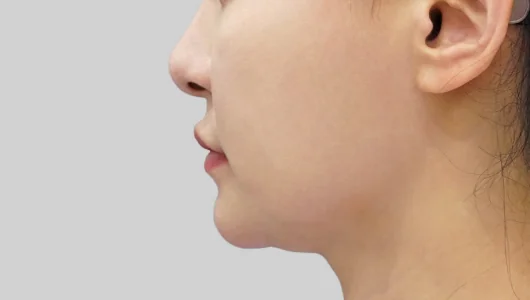 顔の輪郭を整えるチタンリフティング手術前の横顔