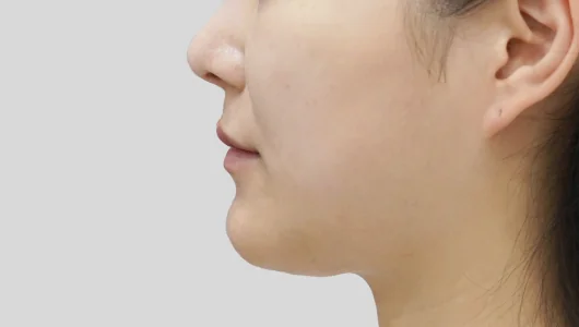 女性の顔の横顔、手術前の状態